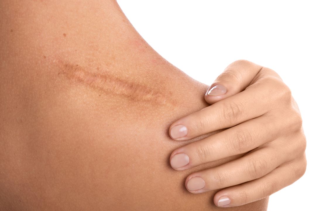 scar therapy in Tarrytown