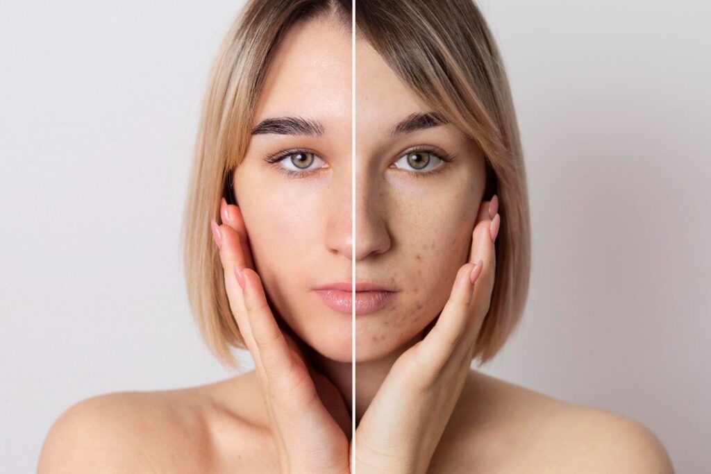 Green Sea Peel Before and After: What Results Can You Expect? At Aesthetics By KM in Irvington, we believe in skincare that delivers visible results—and one treatment that continues to stand out is the Green Sea Peel. As a natural, non-chemical resurfacing option, it offers powerful exfoliation and rejuvenation without the harsh side effects of synthetic alternatives. In this guide, we’ll break down exactly what you can expect before and after a Green Sea Peel, why it’s effective, and how to maintain your glowing results. If you're curious about this trending treatment and want a natural boost for your skin, keep reading. What Is a Green Sea Peel? A Green Sea Peel is a type of herbal microneedling. It's derived from marine-based spicules—microscopic needle-like structures from sea sponges. These spicules gently penetrate the skin's surface, triggering cellular turnover, collagen production, and deep exfoliation. Unlike traditional chemical peels, this method uses physical stimulation rather than acids to renew your skin. This makes it a preferred option for many clients, especially those looking for a natural skincare solution in Irvington. Green Sea Peel Before and After: Visible Transformations Let’s get right to it—what can you really expect from Green Sea Peel before and after? Before Treatment Your skin may be dull, congested, or uneven. Concerns like acne scars, fine lines, or hyperpigmentation might be more prominent. This is the stage where most clients in Irvington begin seeking something more than a basic facial—a treatment with depth and visible results. Before your session at Aesthetics By KM, we conduct a professional consultation to assess your skin type and customize the peel intensity. Immediately After Treatment Expect your skin to feel warm and slightly tingly. Redness is common and can last for 24 to 48 hours. Your skin will begin to tighten as the spicules stimulate cellular activity. Unlike traditional peels, there is no major skin shedding—but you’ll feel the rejuvenation process happening beneath the surface. After 3 to 7 Days This is when the magic unfolds. Most clients in Irvington report a brighter, clearer complexion. Acne lesions begin to flatten, pores appear tighter, and overall texture improves. You’ll likely notice a reduction in pigmentation and a more even skin tone. By comparing Green Sea Peel before and after photos, the difference in clarity, smoothness, and vibrancy is undeniable. Why Choose Green Sea Peel Over Traditional Peels? When comparing natural treatments to chemical peels, the benefits of the Green Sea Peel stand out. Here’s why: Gentler on Sensitive Skin: No synthetic acids mean less irritation. Natural Ingredients: Ideal for clients looking for holistic skincare in Irvington. Quick Recovery: Minimal downtime, so you can return to your routine faster. Effective on Multiple Skin Issues: From acne scars to dullness, the results speak for themselves. You can check out how our clients rate us on Google Maps—we’re proud to be a go-to for Green Sea Peel before and after transformations in the Irvington area. Ideal Candidates for a Green Sea Peel This treatment is suitable for most skin types, but especially beneficial if you: Struggle with acne or acne scars Have hyperpigmentation or melasma Deal with uneven skin tone and texture Prefer natural over synthetic skincare Are located in Irvington and want accessible, local skin care options What Makes Aesthetics By KM the Best Choice? Located in the heart of Irvington, Aesthetics By KM is known for personalized skincare solutions and advanced treatments. Our Green Sea Peel sessions are tailored to your skin’s needs, ensuring safe, transformative results. We pride ourselves on creating a comfortable space, where education, skincare science, and luxury treatments intersect. Visit aestheticsbykm.com to explore our full range of treatments and read client testimonials. Green Sea Peel Before and After: What Makes It Work? Let’s dive deeper into why this treatment is so effective: Physical Exfoliation: The spicules create micro-channels that naturally exfoliate and renew. Boosts Collagen: Encourages firmer, plumper skin over time. Natural Detoxification: Clears congestion and supports the lymphatic system. Supports Even Skin Tone: Gradually reduces dark spots and pigmentation. Strengthens Skin Barrier: Rejuvenates without stripping the skin. All these benefits contribute to stunning Green Sea Peel before and after results that Irvington clients rave about. Green Sea Peel Before and After in Irvington: What Our Clients Say Here’s what some of our clients from Irvington and nearby towns have shared: “I was nervous about trying a new treatment, but Aesthetics By KM made the process so relaxing. A week later, my skin was noticeably clearer and brighter.” – Sarah M. “I loved that it was all-natural. The texture of my skin improved dramatically, and even my old acne marks faded.” – Lena R. H2: Green Sea Peel Before and After—See the Difference Yourself Consistency is key to getting long-term results. Many clients notice progressive improvements after a series of Green Sea Peels spaced 4 to 6 weeks apart. Remember, Green Sea Peel before and after changes don’t stop after one session. Cumulative results often include: Smoother texture Reduced breakouts More radiant tone Diminished scars and marks For the best results, we recommend a personalized aftercare plan—something we’ll discuss during your appointment. How to Prepare and Care for Your Skin Before: Stop using retinols 3–5 days before. Avoid sun exposure and tanning. Hydrate your skin with gentle moisturizers. After: Use SPF 30+ daily. Avoid active ingredients like AHAs/BHAs for a week. Stay hydrated and follow a gentle skincare routine. Want more guidance? Check out our aftercare tips to protect your investment. Making the Most of Your Green Sea Peel Results Here’s how to enhance and maintain the benefits: Book treatments every 4–6 weeks for cumulative results. Combine with LED light therapy or hydrating facials between sessions. Use quality, fragrance-free skincare. Residents in Irvington and surrounding areas often combine the Green Sea Peel with our signature facials for optimal glow. Conclusion: Ready to Experience Your Own Before and After? The results of a Green Sea Peel before and after session are more than just skin deep. It's a confidence boost, a reset, and a visible transformation. If you’re in Irvington and looking for natural skincare that truly works, Aesthetics By KM is your trusted partner. Our clients return not just for the results, but for the care, experience, and personalized attention they receive. Call-to-Action: Ready to glow? Book your Green Sea Peel at Aesthetics By KM today and experience the difference. Find us conveniently located in Irvington, just minutes from Main Street. See your Green Sea Peel before and after transformation—and love the skin you’re in. FAQs About Green Sea Peel Before and After 1. What’s the biggest difference in skin after a Green Sea Peel? The most noticeable change is skin brightness and clarity. Pores look smaller, and pigmentation is reduced. 2. Is the Green Sea Peel safe for all skin types? Generally, yes. However, if you have extremely sensitive or broken skin, a consultation is required to determine if it's right for you. 3. How soon can I expect to see results? Most clients in Irvington notice improvements within 3 to 7 days, with continued progress over the next few weeks. 4. How often should I get a Green Sea Peel? For lasting results, we recommend one every 4–6 weeks, depending on your skin's condition and goals. 5. Can I combine Green Sea Peel with other treatments? Absolutely. Many clients pair it with hydration facials or LED therapy for enhanced benefits. Let me know if you’d like this adapted for social media posts or GMB listings as well.