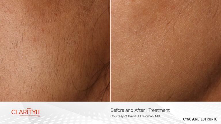 Clarity II laser hair removal