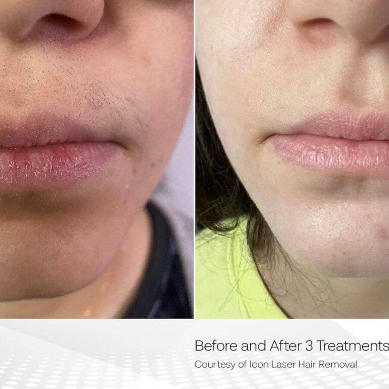 Clarity II laser hair removal