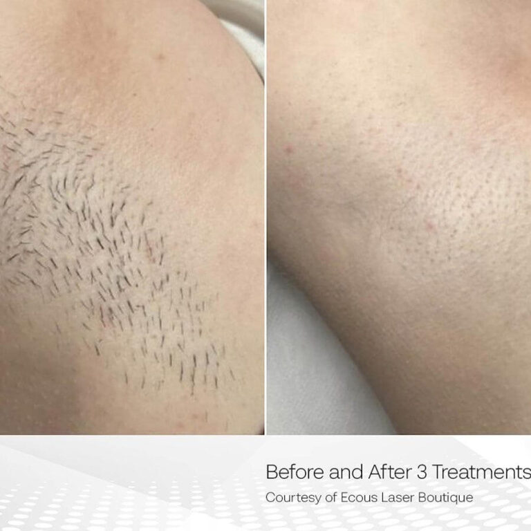 Clarity II laser hair removal