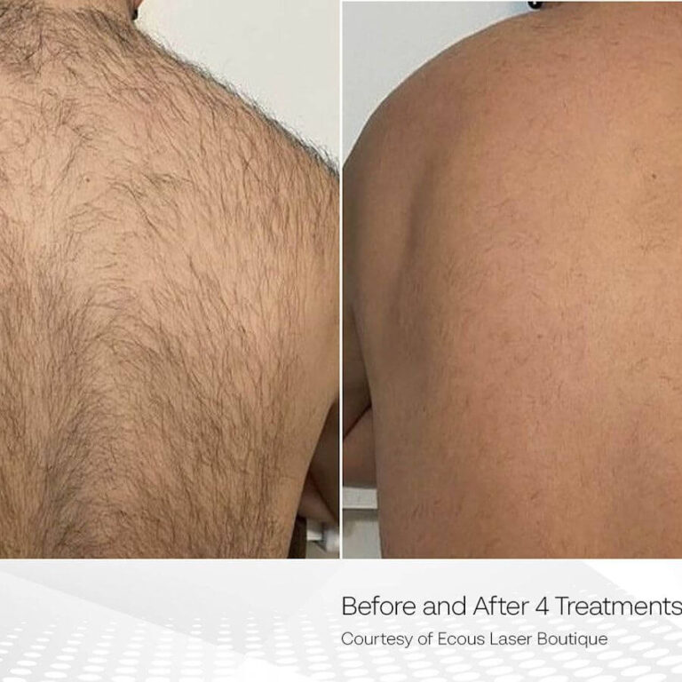 Clarity II laser hair removal